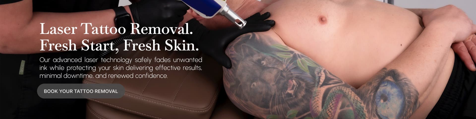 skin-advanced-technology-laser-tattoo-removal