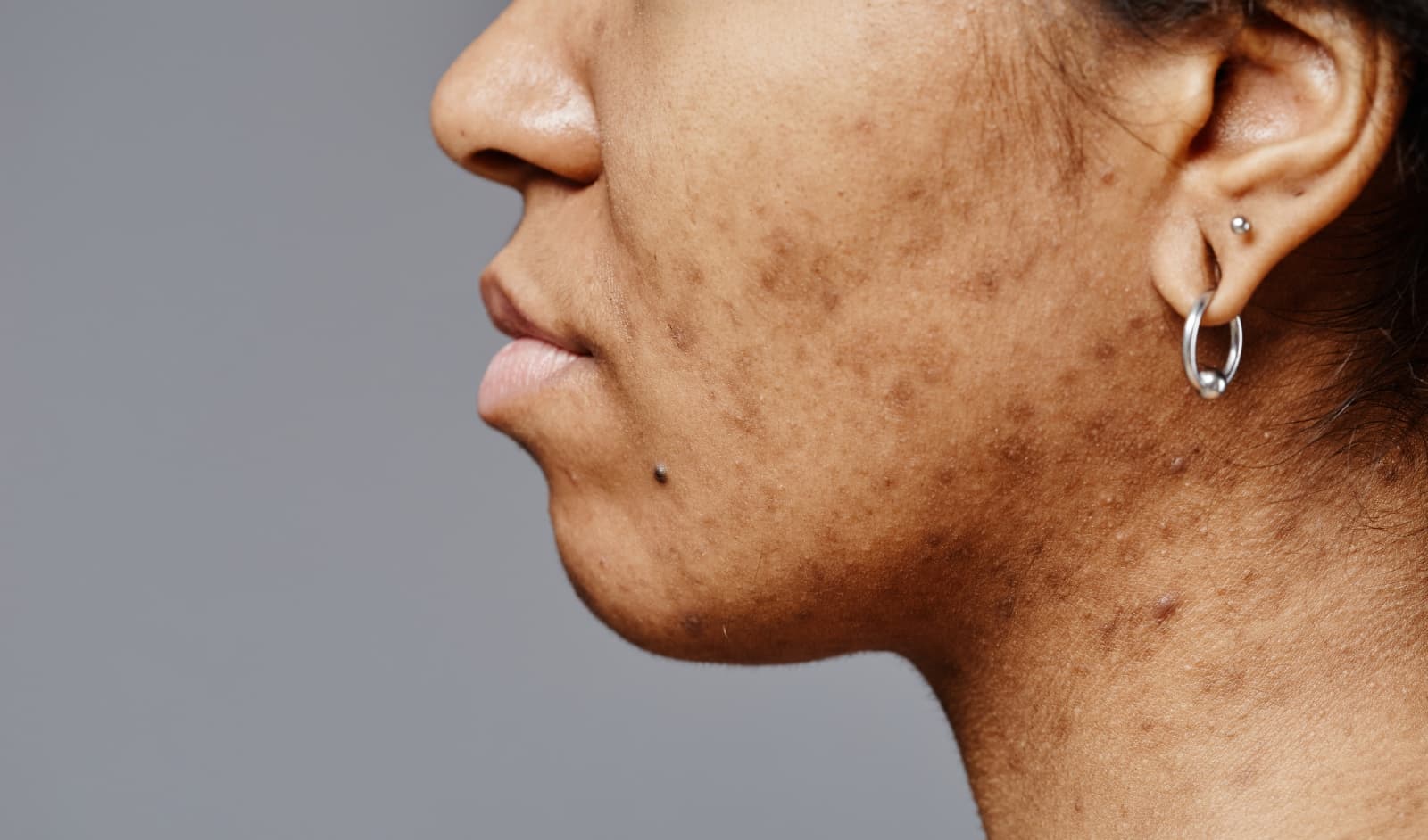 Pigmentation & Uneven Tone