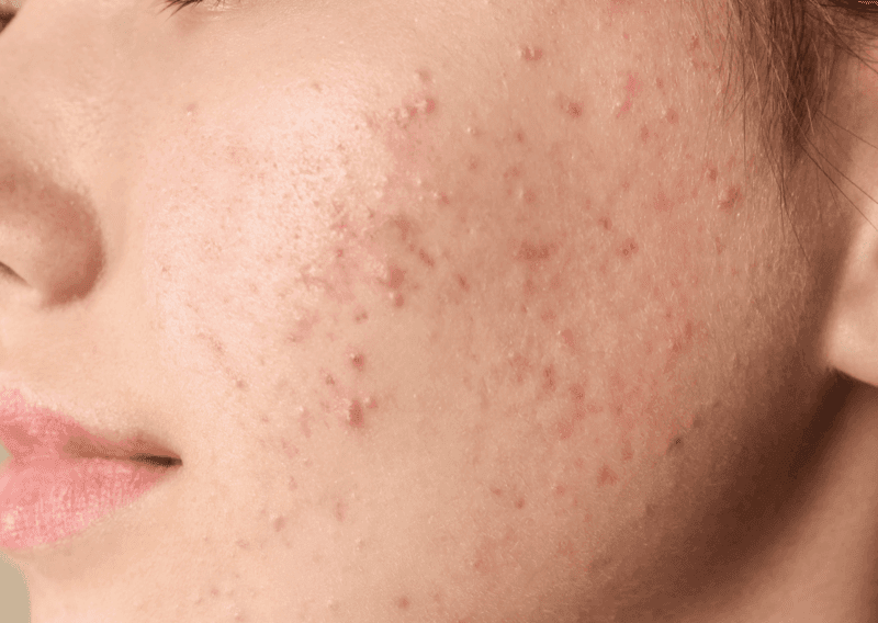 Acne & Breakouts