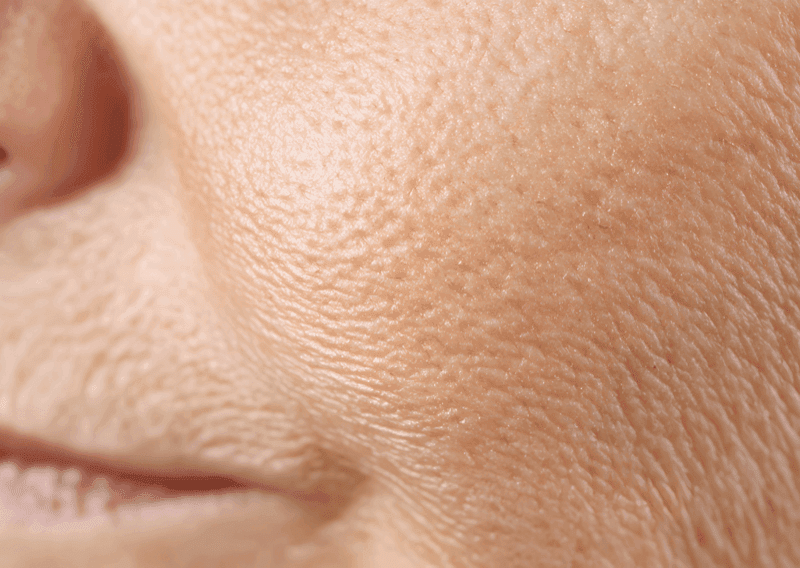 Ageing & Wrinkles