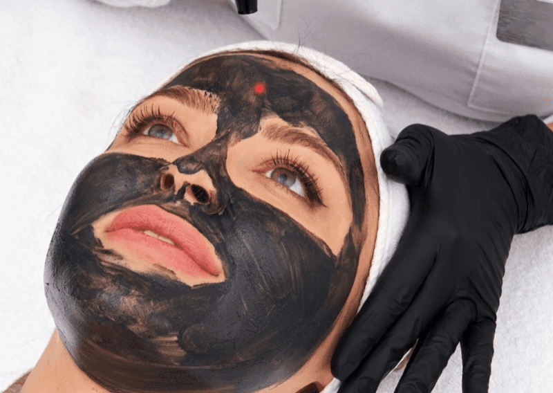 Carbon Laser Peel