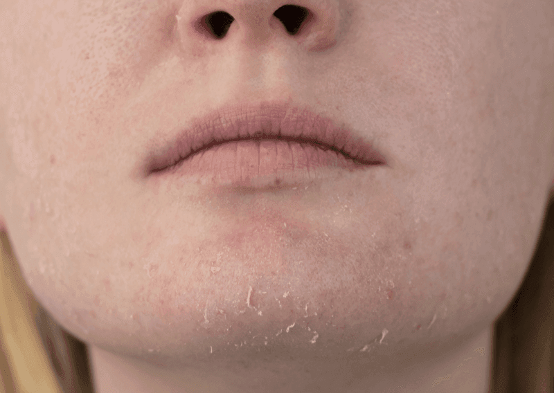 Dryness & Dehydration