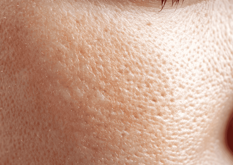 Enlarged Pores & Oily Skin