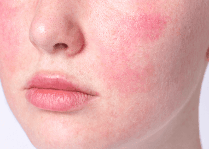 Redness & Sensitivity