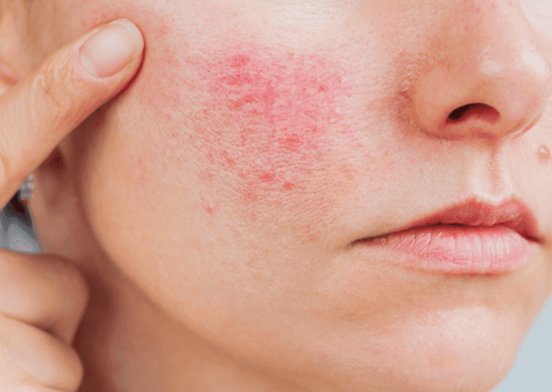 Rosacea