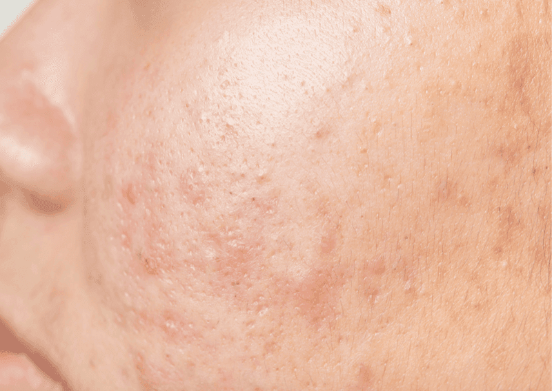 Scarring & Uneven Texture